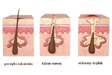 Genital Bölgede Kıl Dönmesi Belirtileri ve Tedavisi